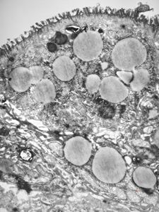 celiakia celiakia